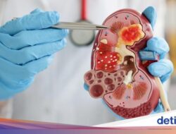 Doyan Minum Manis tapi Ogah Air Putih? Hati-hati, Gangguan Ginjal Menanti