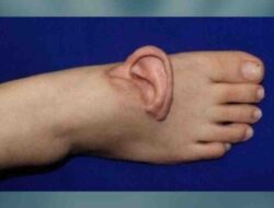 Ahli Bedah China Pindahkan Telinga Wanita Hingga Kaki Di 5 Bulan