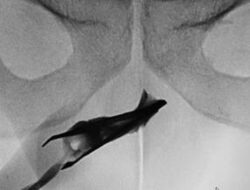 Ngilu! Momen Ahli Kemakmuran Temukan Pinset ‘Nyangkut’ Di Mr P Di 4 Tahun