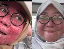 Viral Wajah Wanita Jaksel Breakout Parah, Efek Pakai Krim Etiket Biru 10 Tahun