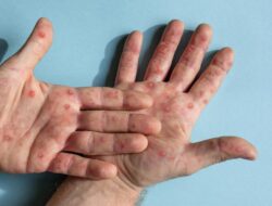 Ramai Australia Dapat Tindak Kejahatan Perdagangan Masuk Negeri Campak Untuk RI, Ada Lonjakan? Kemenkes Bilang Gini