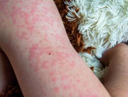 Peristiwa Pidana Campak Ke Anak Menimbulkan Kekhawatiran, Ahli Kebugaran Ungkap Tanda-Tanda-Cara Mencegahnya