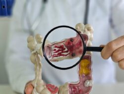 Kanker Usus Besar Mulai Serang Kalangan Anak Muda, Jangan Sepelekan Tanda-Tanda Ini